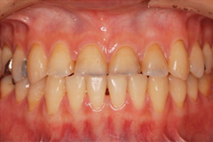 前歯をきれいにしたいという悩みを持った患者さまの症例（20代女性）1