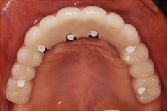 入れ歯から解放されたいという悩みを持った患者さまの症例(40代女性)5