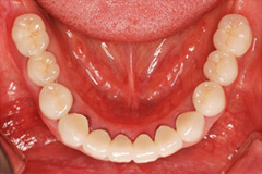 お口全体を治したいという悩みを持った患者さまの症例(50代女性)6