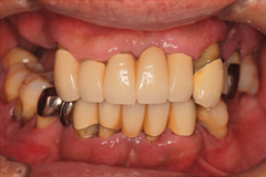 歯が揺れて噛めないという悩みを持った患者さまの症例(50代男性)1