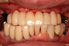 無くした歯を元通りにしたいという悩みを持った患者さまの症例（60代女性）2