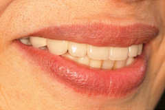 無くした歯を元通りにしたいという悩みを持った患者さまの症例（60代女性）5