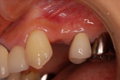 歯の根が割れた患者さまをインプラントにした症例1