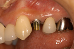 歯の根が割れた患者さまをインプラントにした症例2