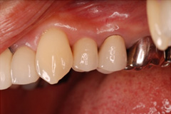 歯の根が割れた患者さまをインプラントにした症例3