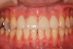 前歯をきれいにしたいという悩みを持った患者さまの症例（20代女性）2