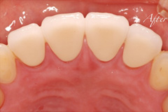 前歯をきれいにしたいという悩みを持った患者さまの症例（20代女性）3