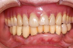 取り外し式の入れ歯がどうしてもイヤという悩みを持った患者さまの症例（80代女性）1