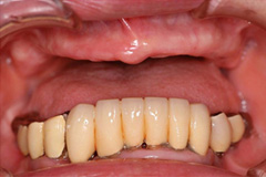 取り外し式の入れ歯がどうしてもイヤという悩みを持った患者さまの症例（80代女性）2