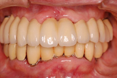 取り外し式の入れ歯がどうしてもイヤという悩みを持った患者さまの症例（80代女性）3
