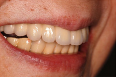取り外し式の入れ歯がどうしてもイヤという悩みを持った患者さまの症例（80代女性）4