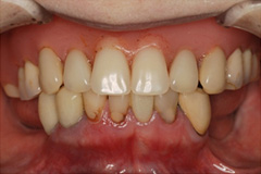 入れ歯から解放されたいという悩みを持った患者さまの症例(40代女性)1