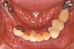 入れ歯から解放されたいという悩みを持った患者さまの症例(40代女性)3