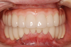入れ歯から解放されたいという悩みを持った患者さまの症例(40代女性)4