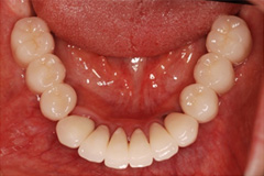 入れ歯から解放されたいという悩みを持った患者さまの症例(40代女性)6