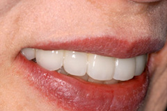 入れ歯から解放されたいという悩みを持った患者さまの症例(40代女性)7