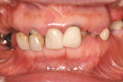 お口全体を治したいという悩みを持った患者さまの症例(50代女性)1