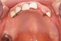 お口全体を治したいという悩みを持った患者さまの症例(50代女性)2