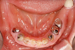 お口全体を治したいという悩みを持った患者さまの症例(50代女性)3