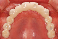 お口全体を治したいという悩みを持った患者さまの症例(50代女性)5