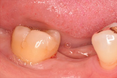 無くした歯を元通りにしたいという悩みを持った患者さまの症例（40代女性）1