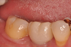 無くした歯を元通りにしたいという悩みを持った患者さまの症例（40代女性）2