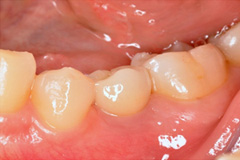無くした歯を元通りにしたいという悩みを持った患者さまの症例(40代女性)3