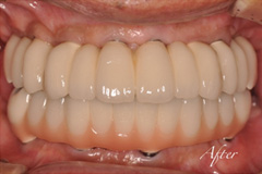 歯が揺れて噛めないという悩みを持った患者さまの症例(50代男性)2