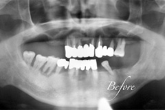 歯が揺れて噛めないという悩みを持った患者さまの症例(50代男性)3