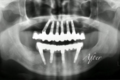 歯が揺れて噛めないという悩みを持った患者さまの症例(50代男性)4
