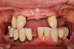 無くした歯を元通りにしたいという悩みを持った患者さまの症例（60代女性）1