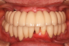 無くした歯を元通りにしたいという悩みを持った患者さまの症例（60代女性）3