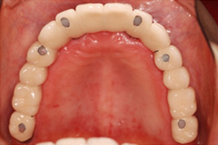 無くした歯を元通りにしたいという悩みを持った患者さまの症例（60代女性）4