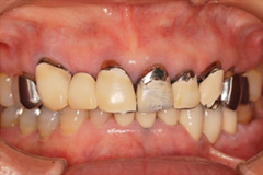 前歯をきれいにしたいという悩みを持った患者さまの症例（60代女性）1