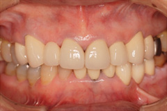 前歯をきれいにしたいという悩みを持った患者さまの症例（60代女性）2