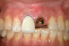 前歯をきれいにしたいという悩みを持った患者さまの症例(60代女性) 1