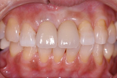 前歯をきれいにしたいという悩みを持った患者さまの症例(60代女性) 2
