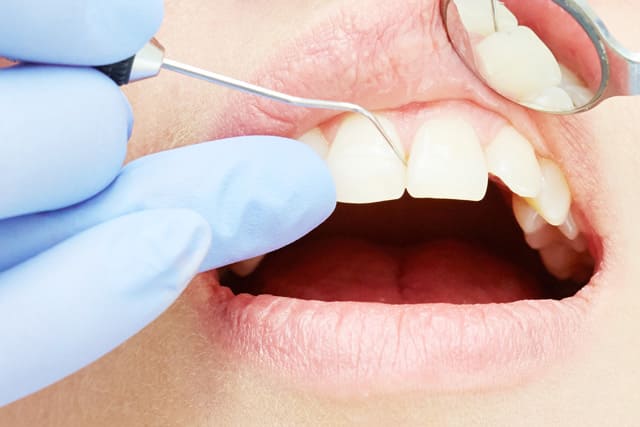 PMTCによる歯垢の除去