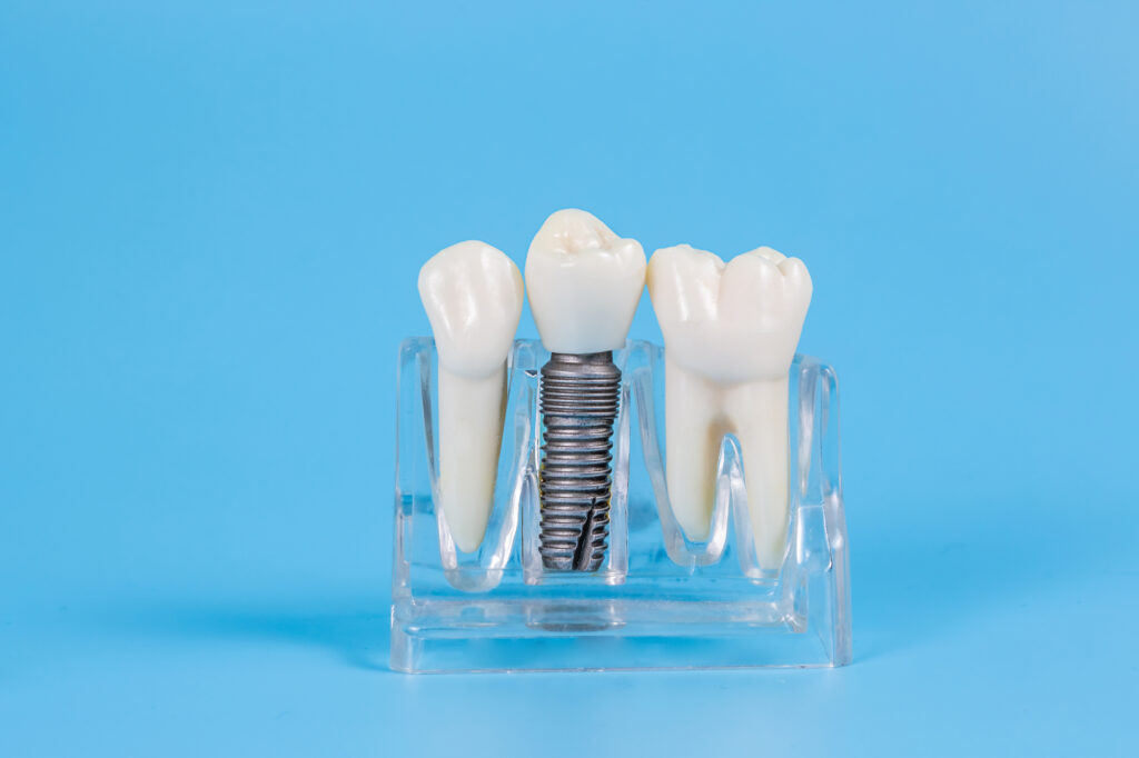 Plastic dental crowns, imitation of a dental prosthesis of a dental bridge for three teeth with a metal screw implant on a blue background.